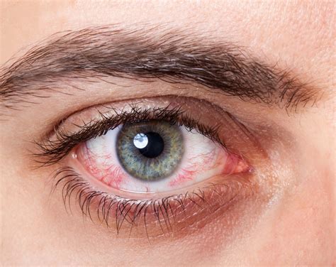 sintomas de derrame ocular